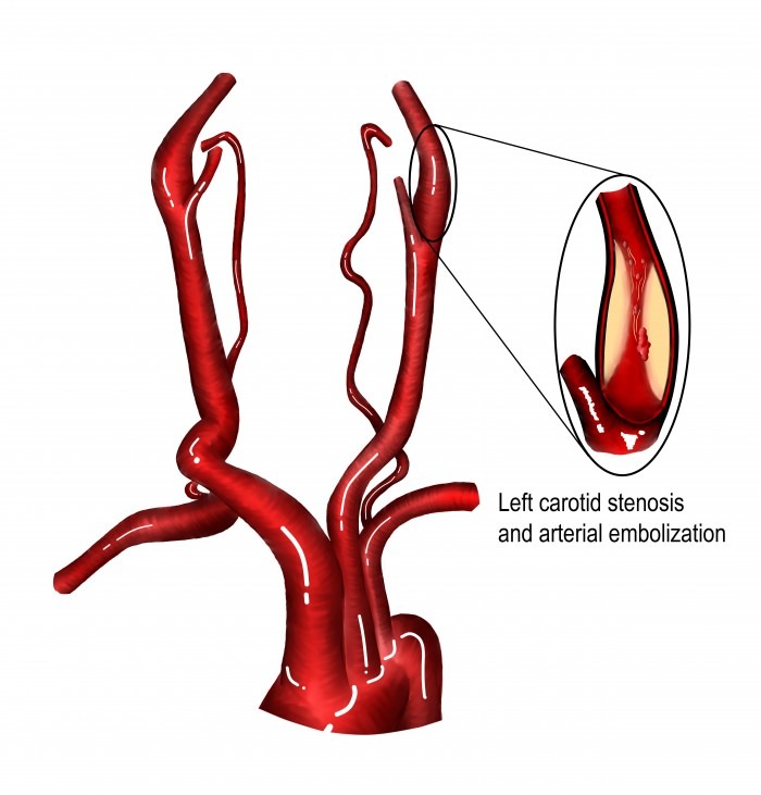 11 Carotid Artery Stenosis Part 1 B Mode And Color Flow 123sonography